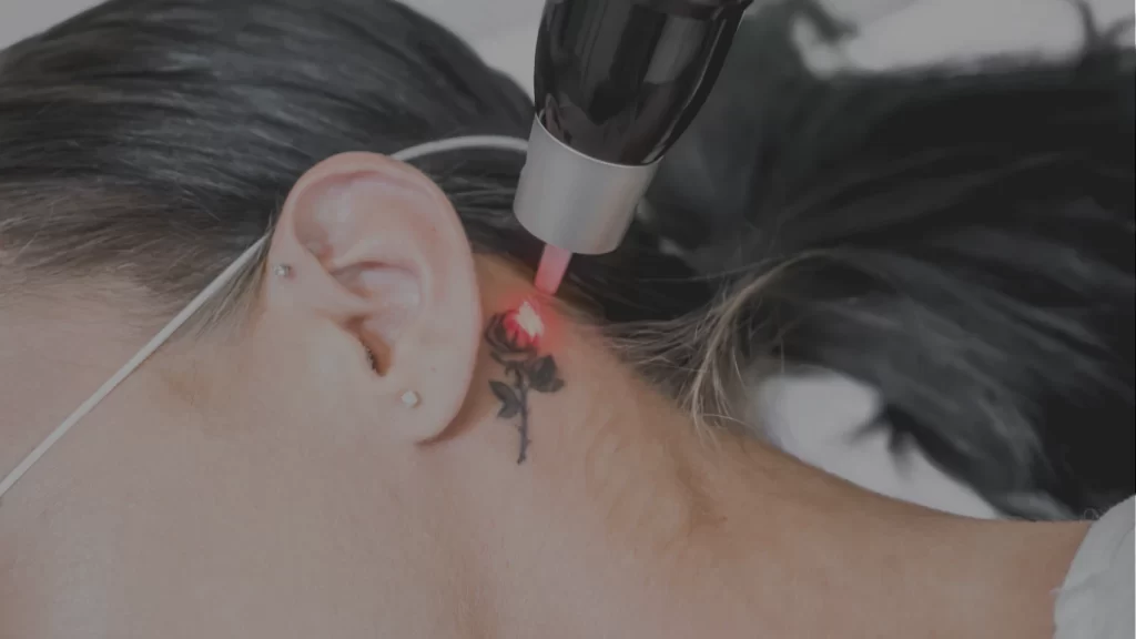 Donde hacerme borrar mi tatuaje en Machala precios
