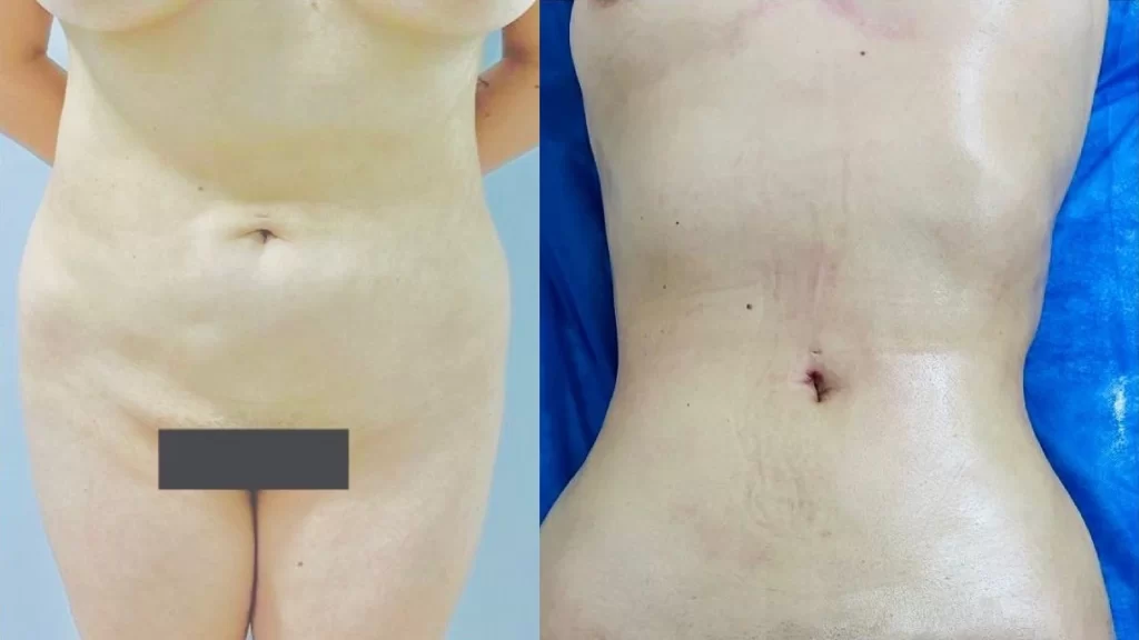 Tratamiento Postoperatorio de cirguia estetica en machala precios