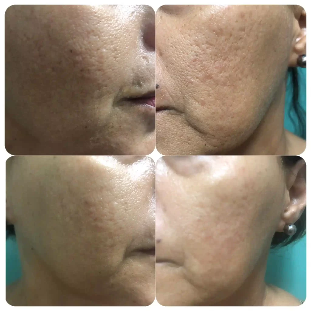 Tratamiento para obtener piel de porcelana cerca de mi machala