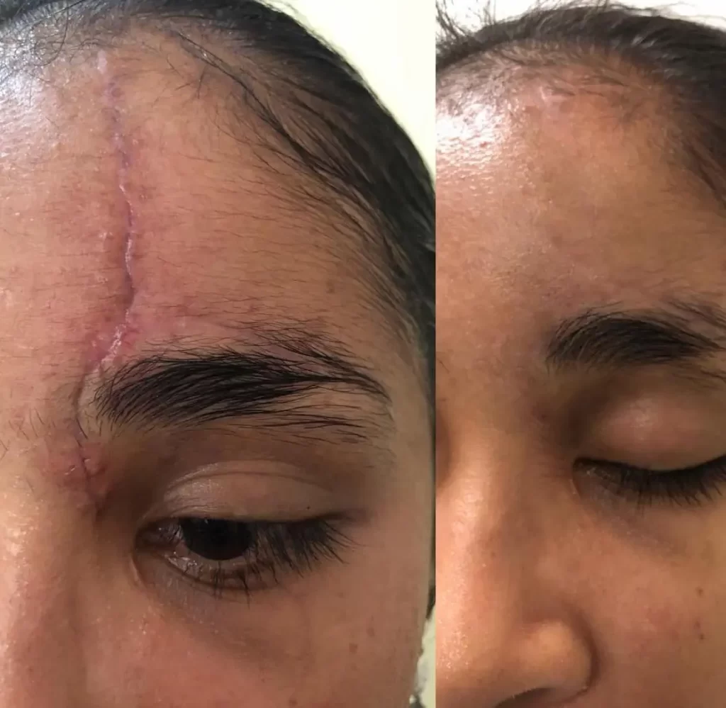 tratamiento de cicatrices con laser en machala precios